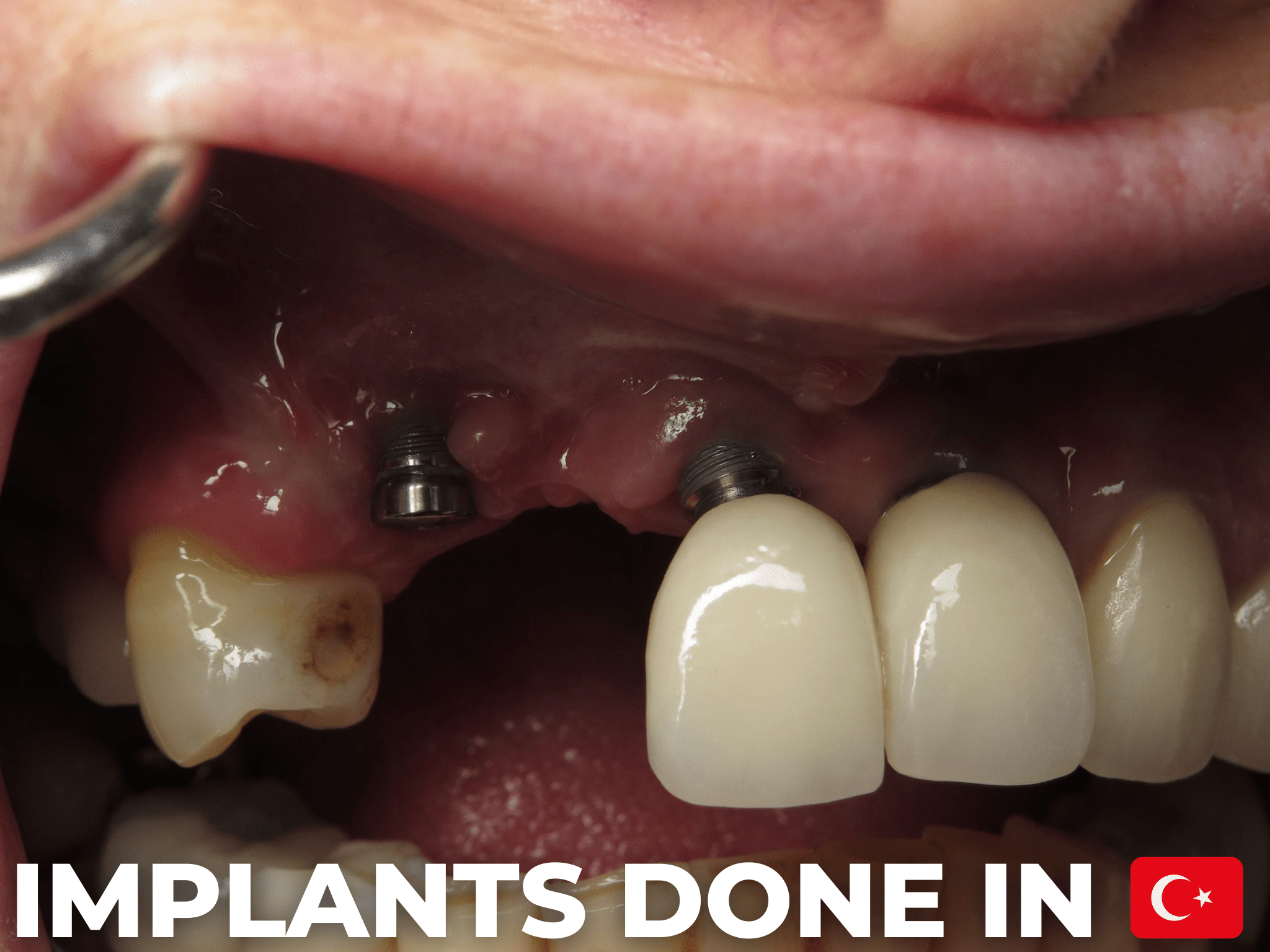 IMPLANTS-DONE-IN - Manchester Dental