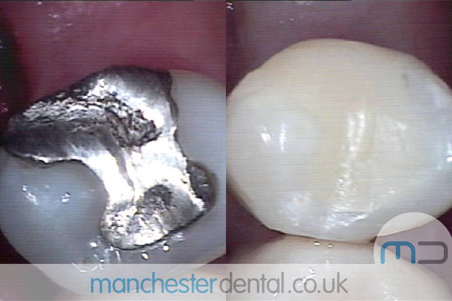 White-Fillings-with-URL_0001_White-Fillings-7