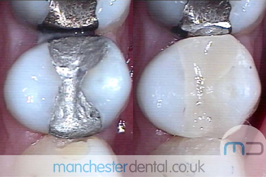 White-Fillings-with-URL_0003_White-Fillings-5