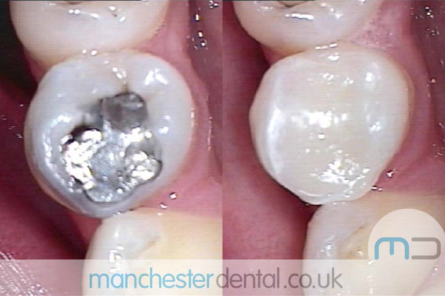 White-Fillings-with-URL_0004_White-Fillings-4