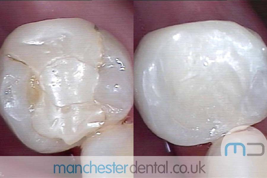 White-Fillings-with-URL_0007_White-Fillings-1