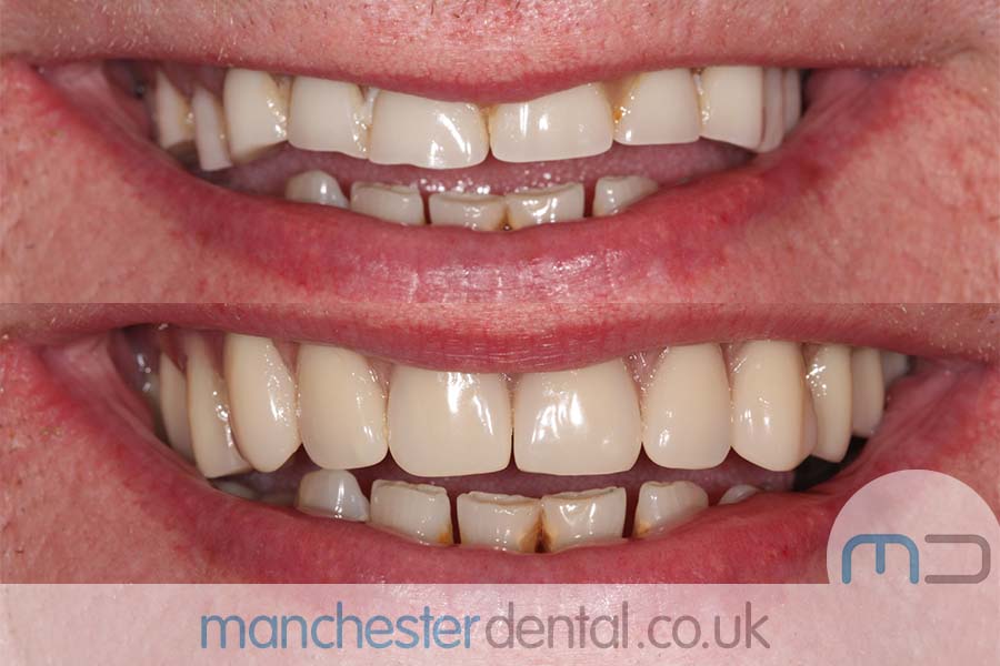 Dentures-manchesterdental-work gallery (2) Dentures-manchesterdental-work gallery (2)