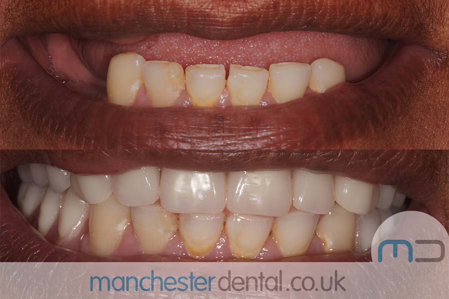 Dentures-manchesterdental-work gallery (5) Dentures-manchesterdental-work gallery (5)