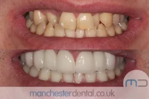 Teeth-Whitening-with-URL_0001_Whitening work gallery (1)