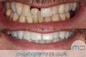 Teeth-Whitening-with-URL_0001_Whitening work gallery (2)