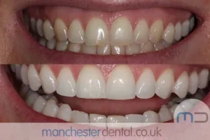 Teeth-Whitening-with-URL_0001_Whitening work gallery (3)