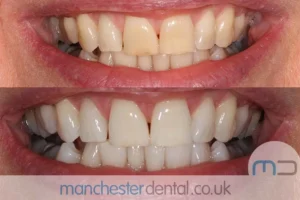 Teeth-Whitening-with-URL_0001_Whitening work gallery (4)