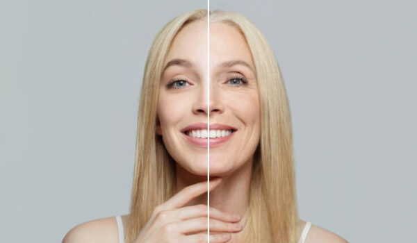 anti wrinkle treatment
