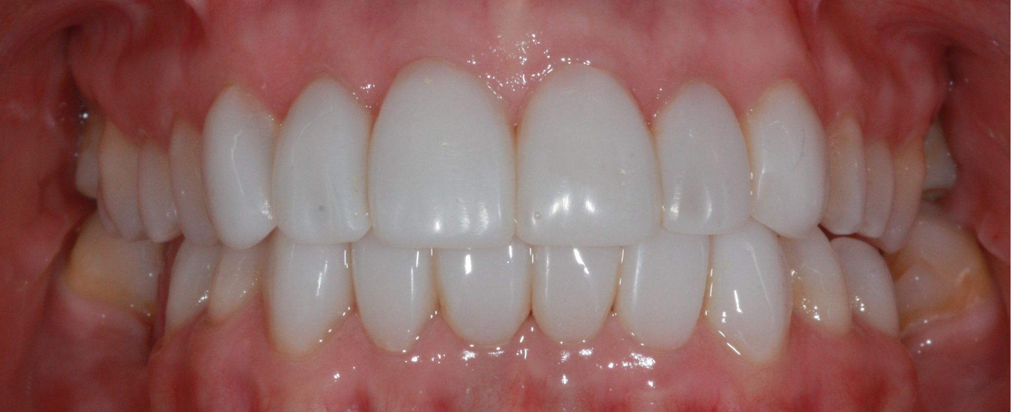 composite bonding-gallery-1 composite bonding-gallery-1