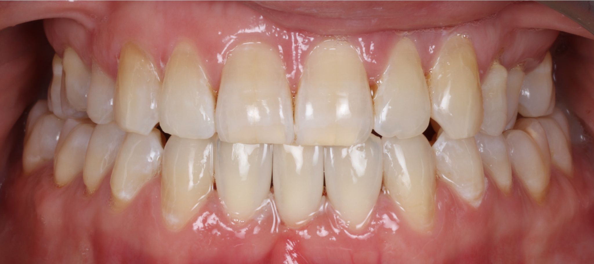 composite bonding-gallery-10