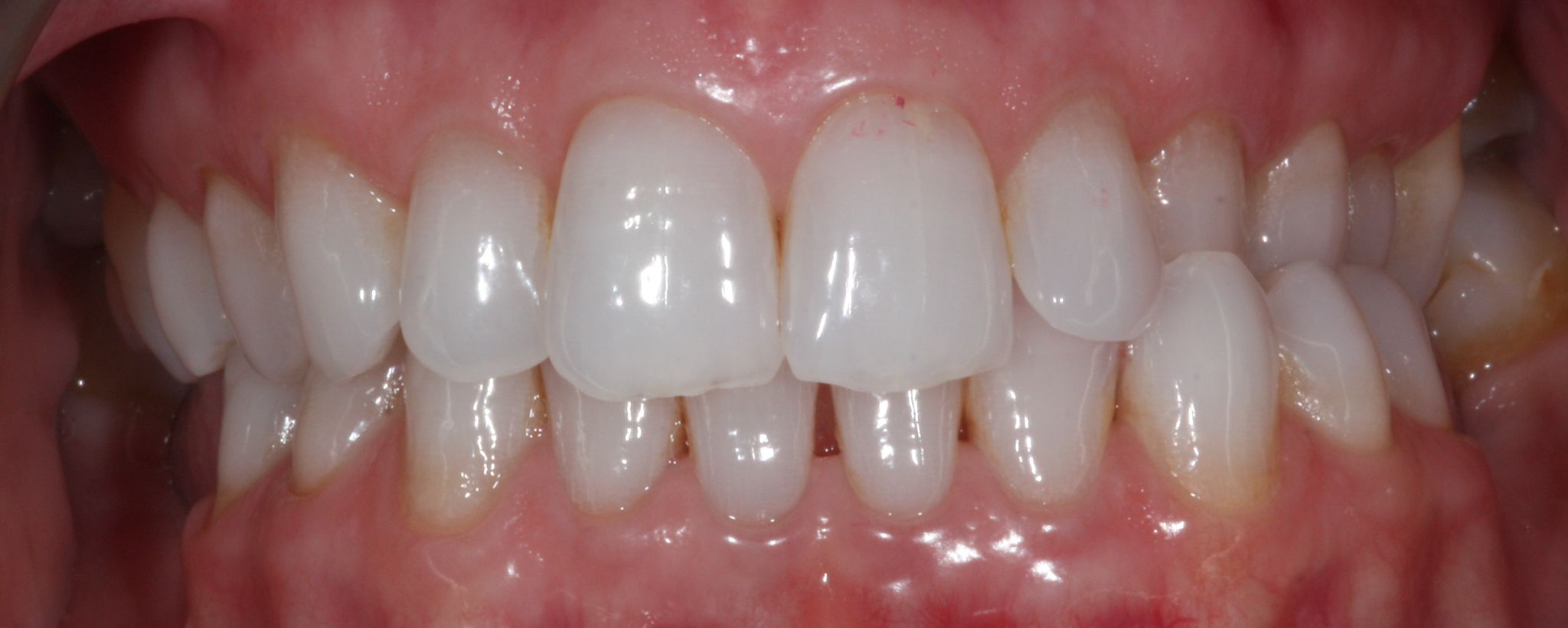 composite bonding-gallery-2