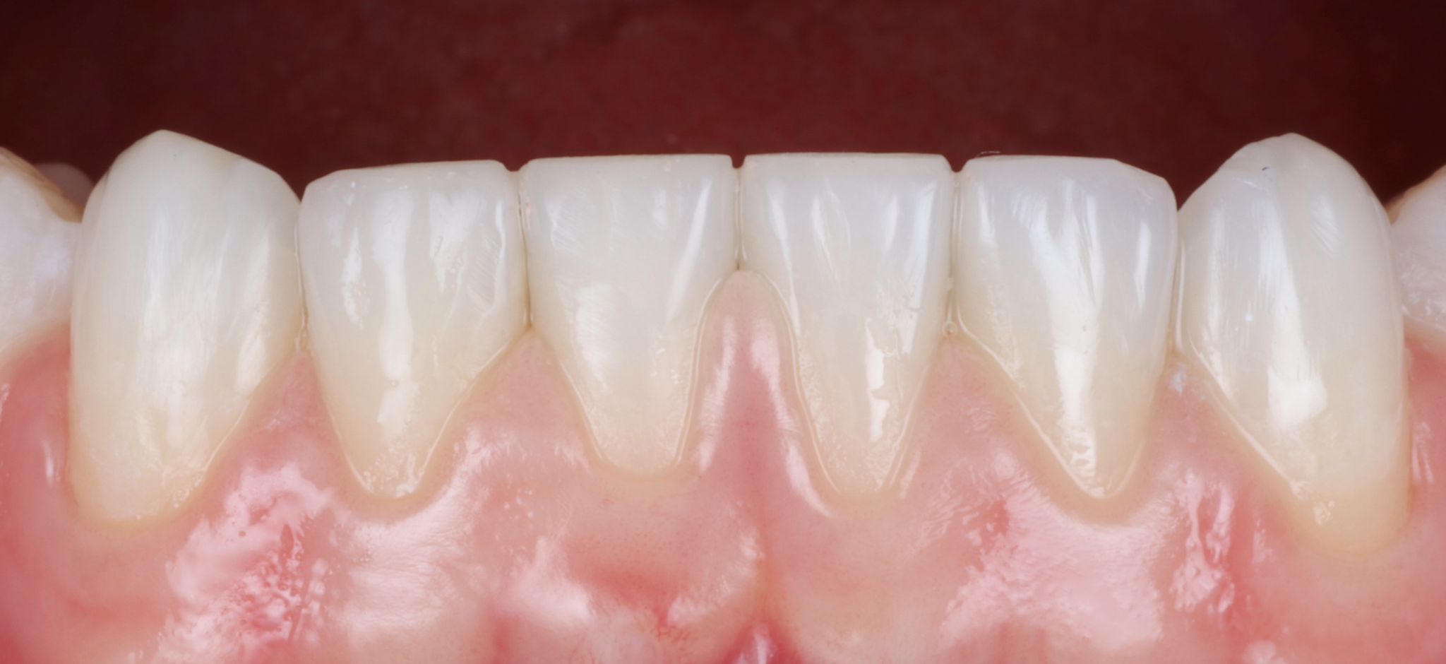 composite bonding-gallery-3