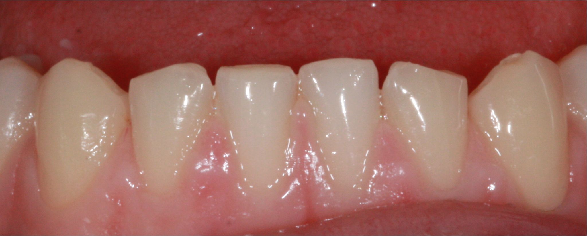 composite bonding-gallery-4 composite bonding-gallery-4