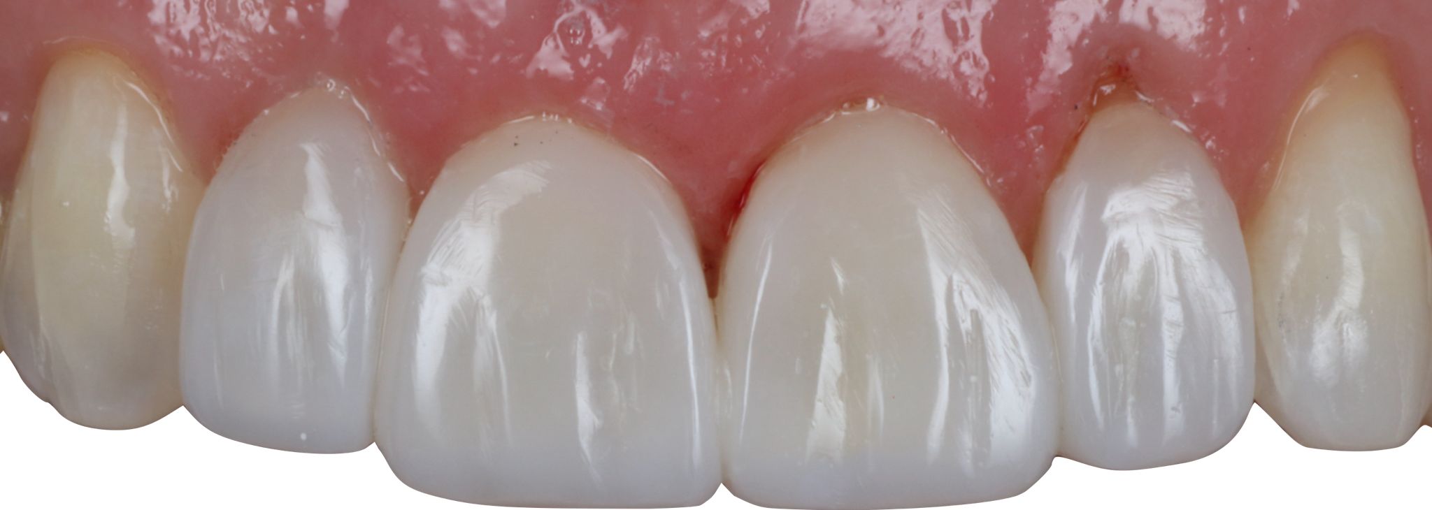 composite bonding-gallery-5