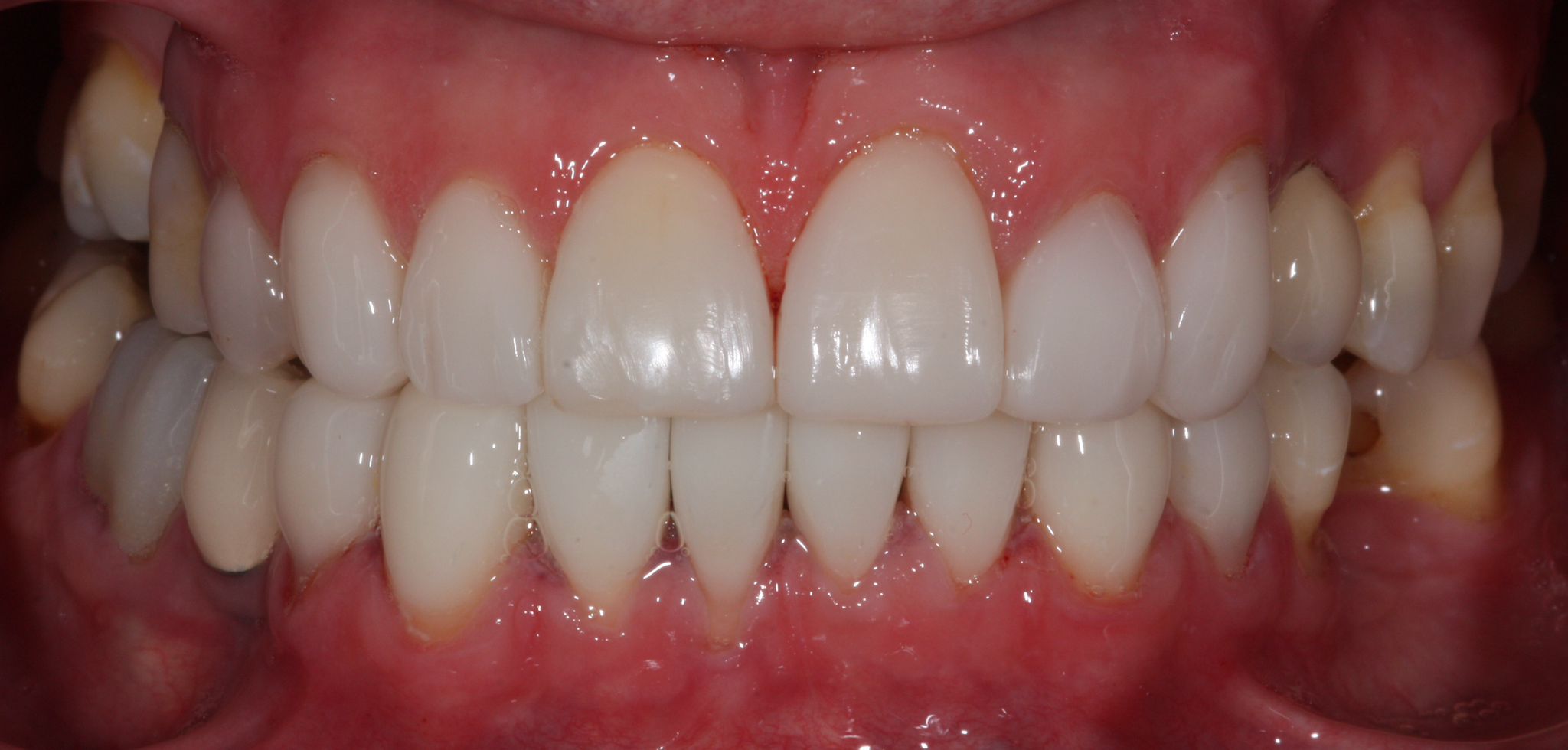 composite bonding-gallery-7