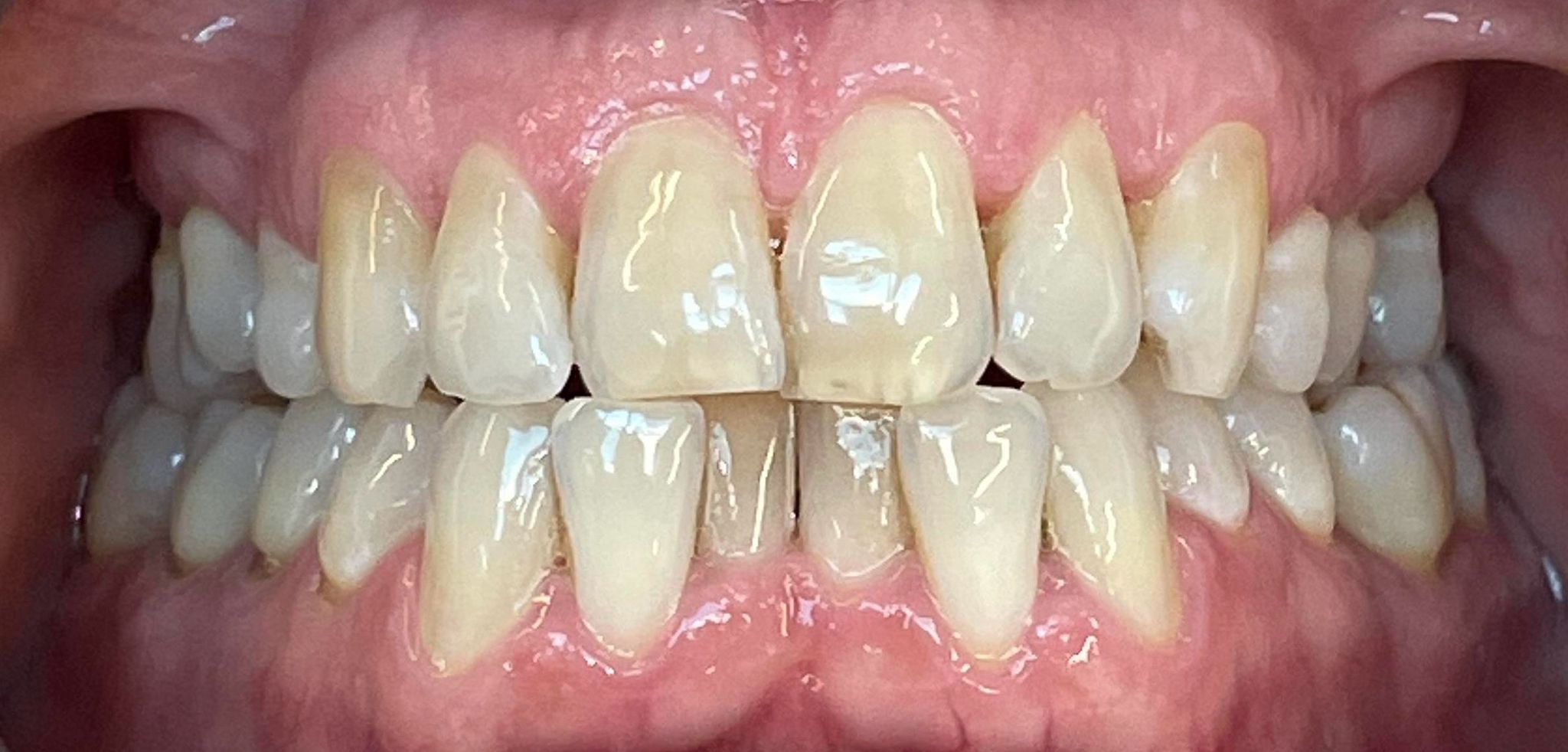 composite bonding-gallery-9 composite bonding-gallery-9