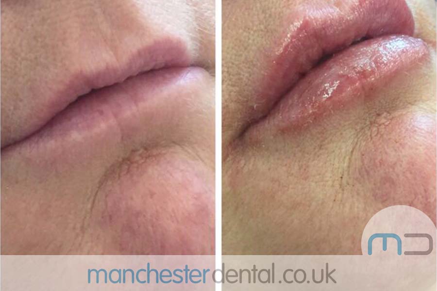 manchester dental -anti wrinkle treatments- (10) manchester dental -anti wrinkle treatments- (10)