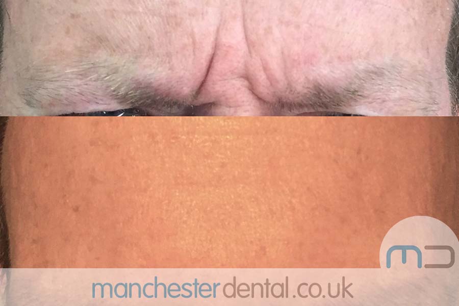 manchester dental -anti wrinkle treatments- (11) manchester dental -anti wrinkle treatments- (11)