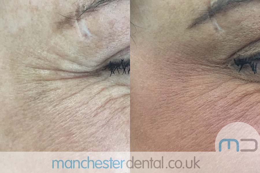 manchester dental -anti wrinkle treatments- (2) manchester dental -anti wrinkle treatments- (2)