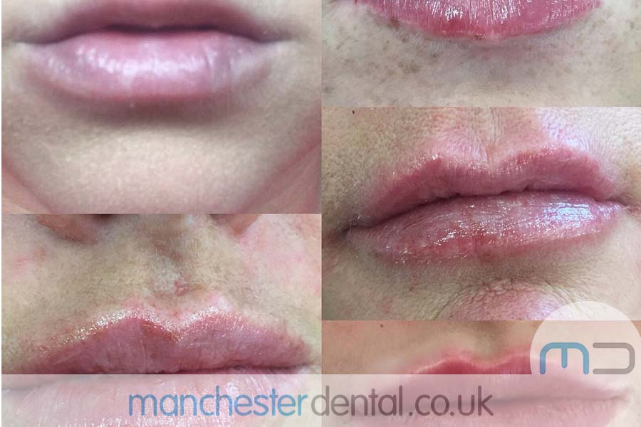 manchester dental -anti wrinkle treatments- (3) manchester dental -anti wrinkle treatments- (3)