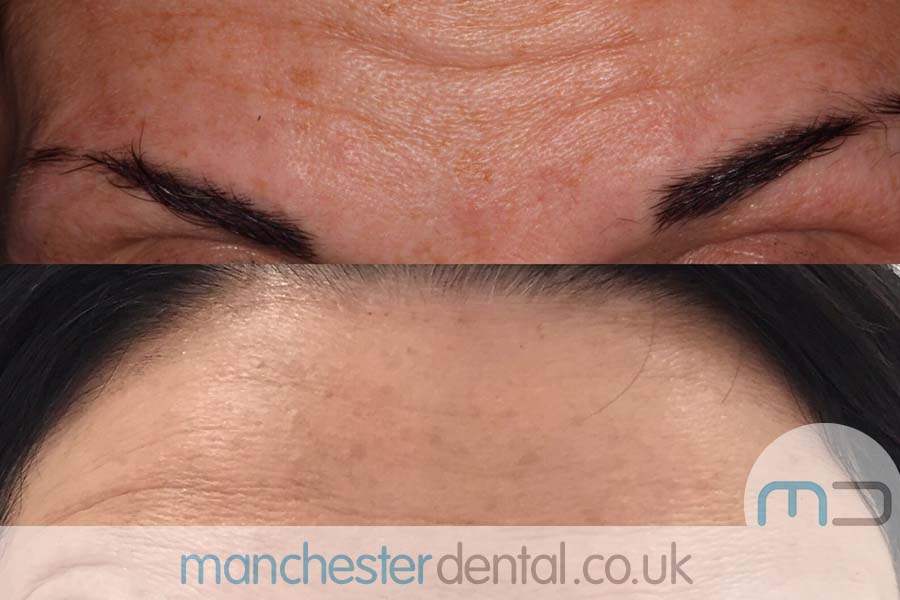 manchester dental -anti wrinkle treatments- (5) manchester dental -anti wrinkle treatments- (5)