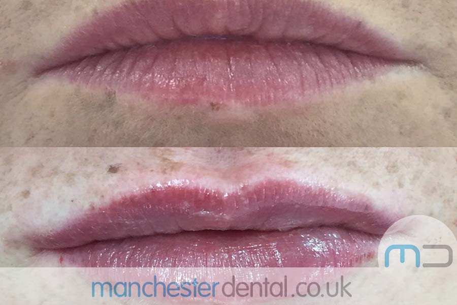 manchester dental -anti wrinkle treatments- (6) manchester dental -anti wrinkle treatments- (6)