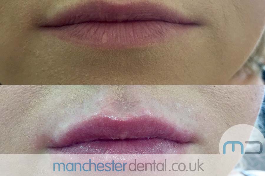 manchester dental -anti wrinkle treatments- (7) manchester dental -anti wrinkle treatments- (7)