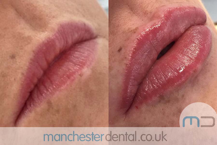 manchester dental -anti wrinkle treatments- (8) manchester dental -anti wrinkle treatments- (8)