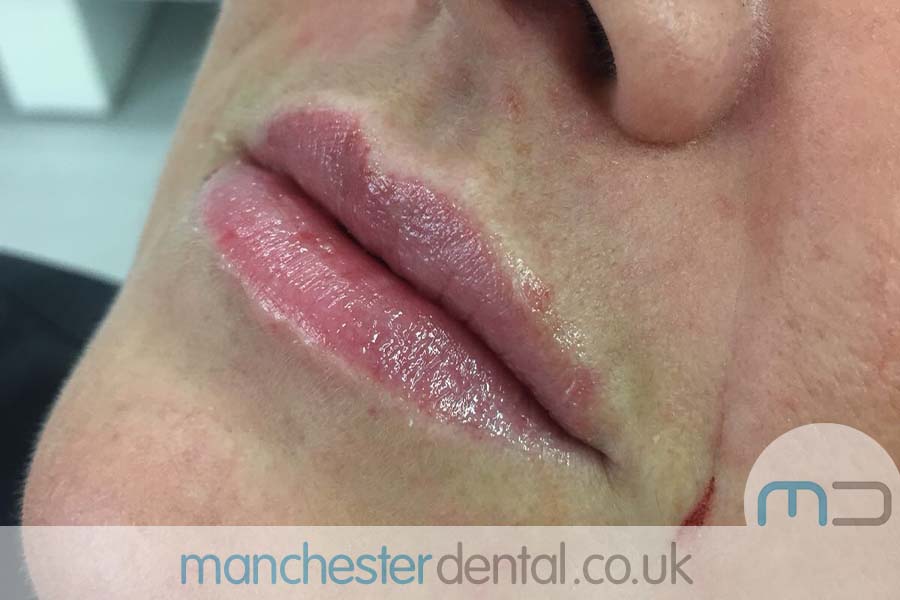 manchester dental -anti wrinkle treatments- (9) manchester dental -anti wrinkle treatments- (9)