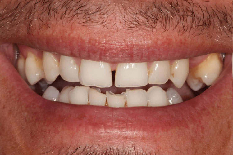 manchester-dental-dental-crowns-before-after--1 manchester-dental-dental-crowns-before-after--1
