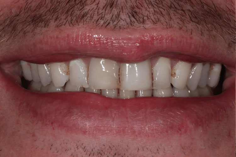 manchester-dental-dental-crowns-before-after--2 manchester-dental-dental-crowns-before-after--2