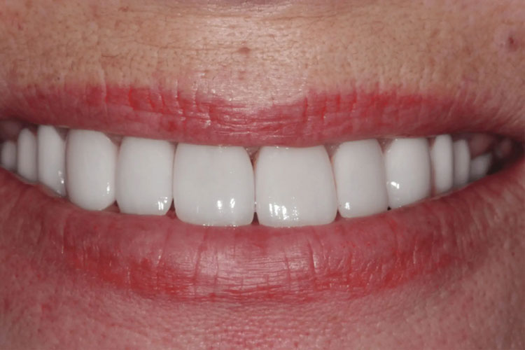 manchester-dental-dental-crowns-before-after--3