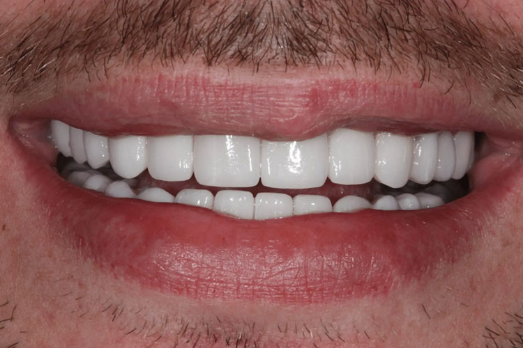 manchester-dental-dental-crowns-before-after--7