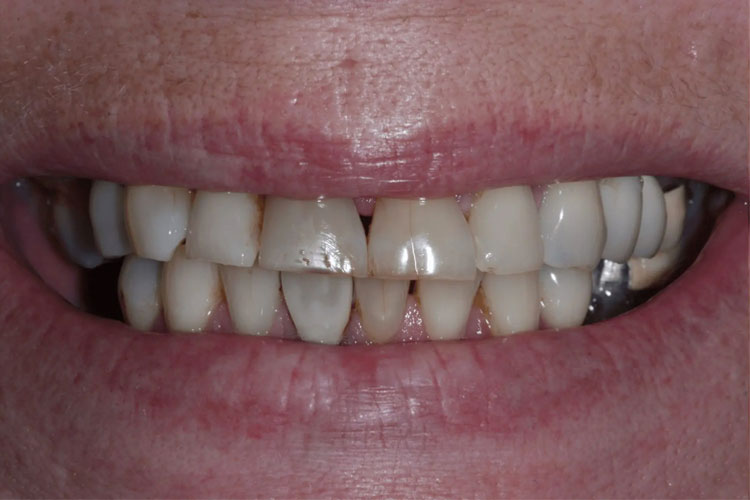 manchester-dental-dental-crowns-before-after--8 manchester-dental-dental-crowns-before-after--8
