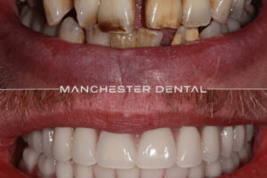 manchester-dental-implants-case-study (1) manchester-dental-implants-case-study (1)