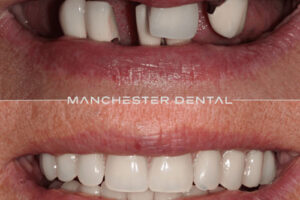 manchester-dental-implants-case-study (11) manchester-dental-implants-case-study (11)