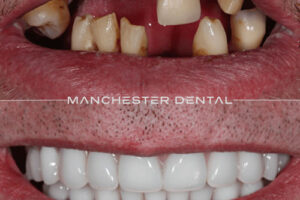manchester-dental-implants-case-study (13) manchester-dental-implants-case-study (13)