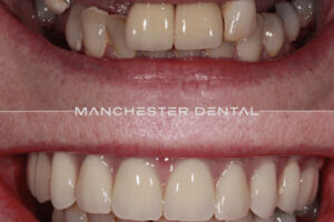 manchester-dental-implants-case-study (15) manchester-dental-implants-case-study (15)