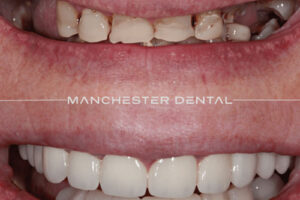 manchester-dental-implants-case-study (17) manchester-dental-implants-case-study (17)