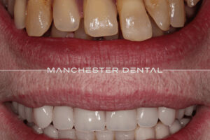 manchester-dental-implants-case-study (19) manchester-dental-implants-case-study (19)