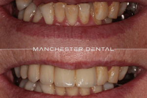 manchester-dental-implants-case-study (23) manchester-dental-implants-case-study (23)