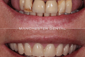 manchester-dental-implants-case-study (25) manchester-dental-implants-case-study (25)
