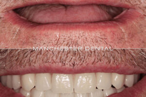 manchester-dental-implants-case-study (27) manchester-dental-implants-case-study (27)