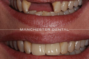 manchester-dental-implants-case-study (29) manchester-dental-implants-case-study (29)