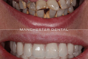 manchester-dental-implants-case-study (5) manchester-dental-implants-case-study (5)