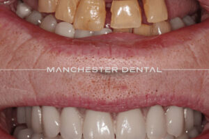 manchester-dental-implants-case-study (7) manchester-dental-implants-case-study (7)
