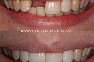 manchester-dental-implants-case-study (9) manchester-dental-implants-case-study (9)