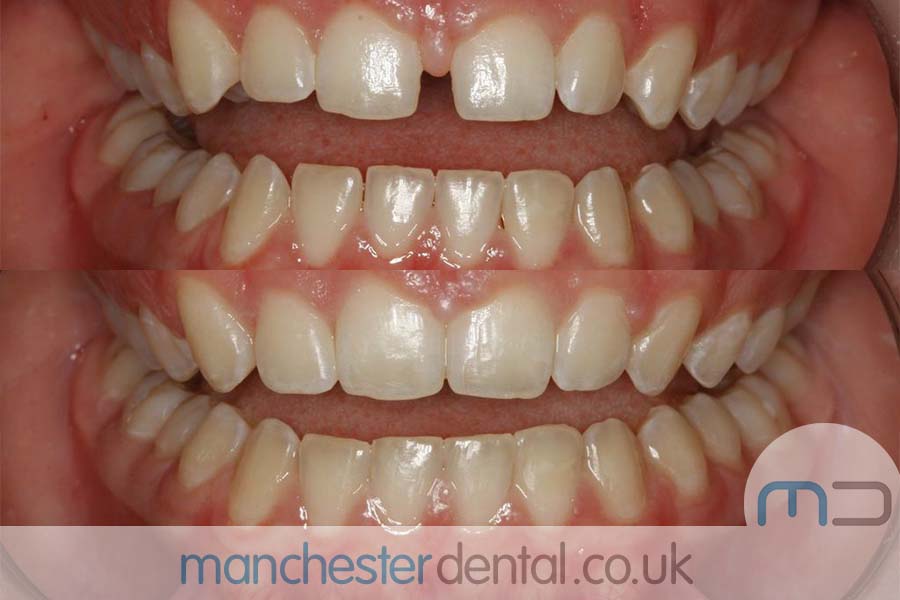 manchester dental orthodontics work gallery (4) manchester dental orthodontics work gallery (4)