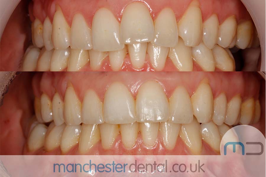 manchester dental orthodontics work gallery (5) manchester dental orthodontics work gallery (5)