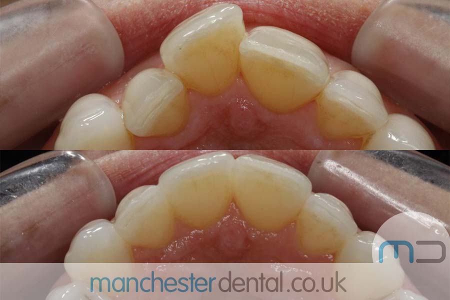 manchester dental orthodontics work gallery (7) manchester dental orthodontics work gallery (7)